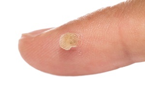 Κονδυλωμάτων - μια ασθένεια του δέρματος που αποτελεσματικά καταπολεμά Skincell Pro